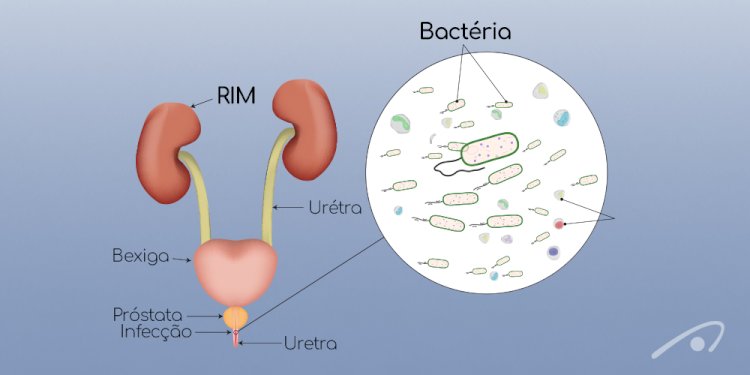 Trabalho sobre Infecções Gonocócicas